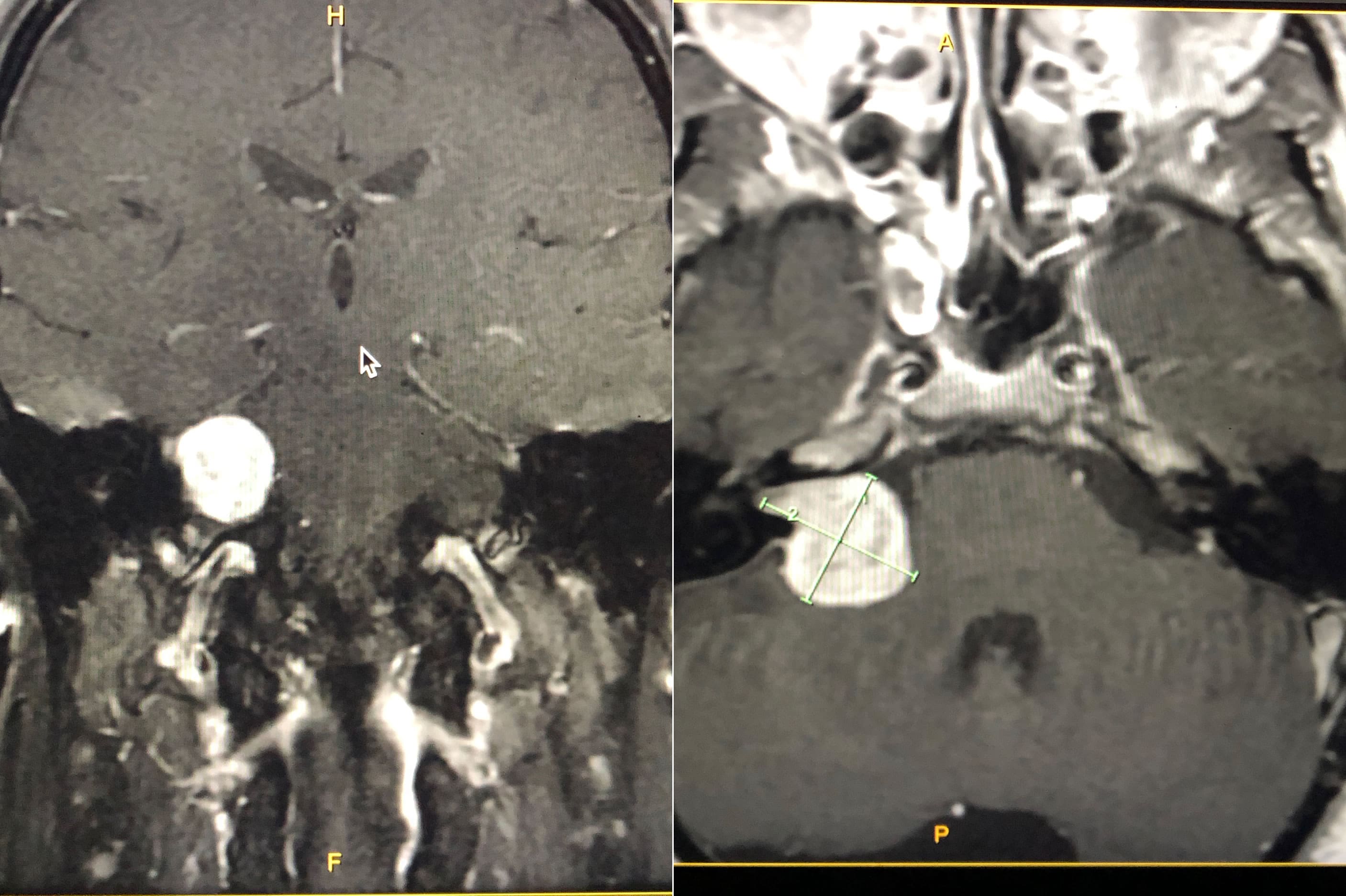 Acoustic Neuroma