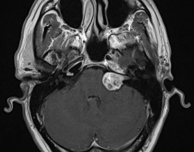 MRI Images of Large Acoustic Neuroma