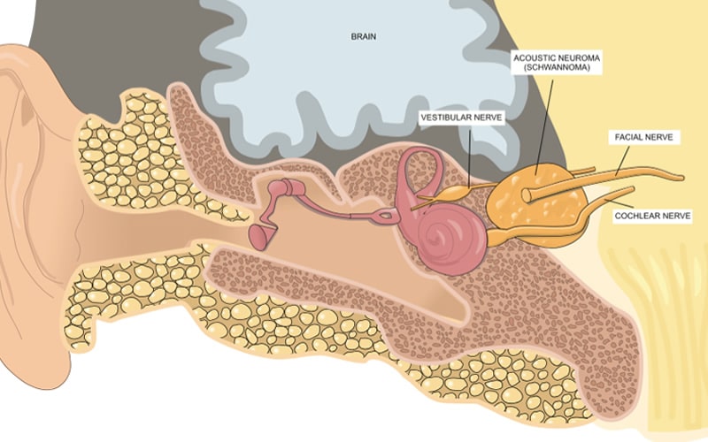 Acoustic Neuroma