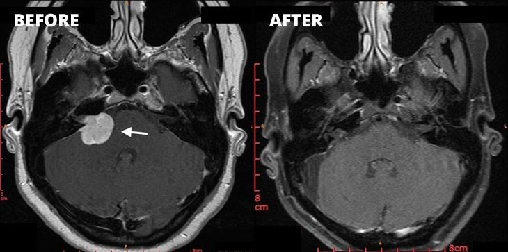 Case study Acoustic Neuroma
