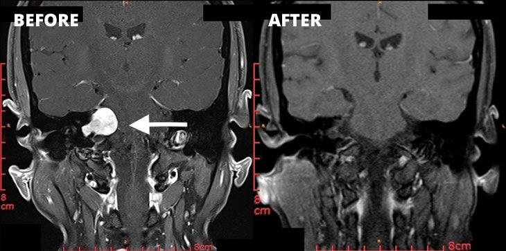 Case study Acoustic Neuroma