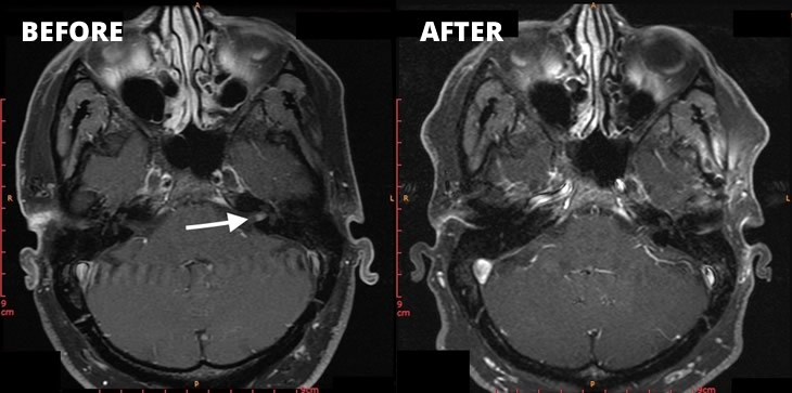 Case study Acoustic Neuroma