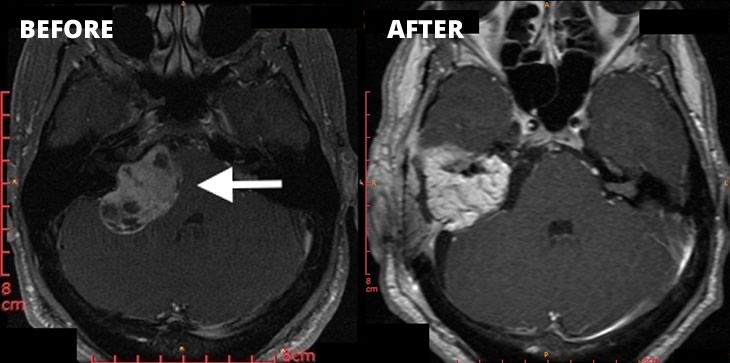 Case study Acoustic Neuroma