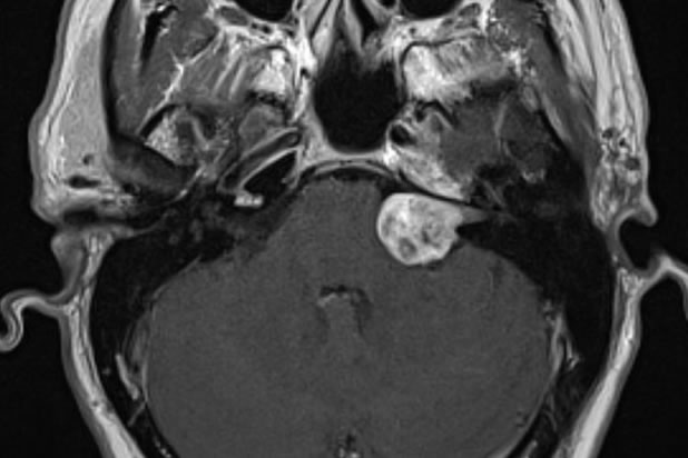 MRI