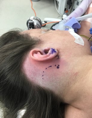 Retrosigmoid Resection Approach